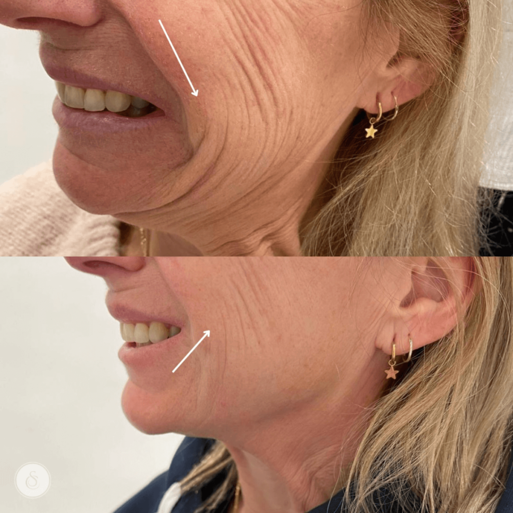 Rimpels verwijderen met botox sarasin clinic