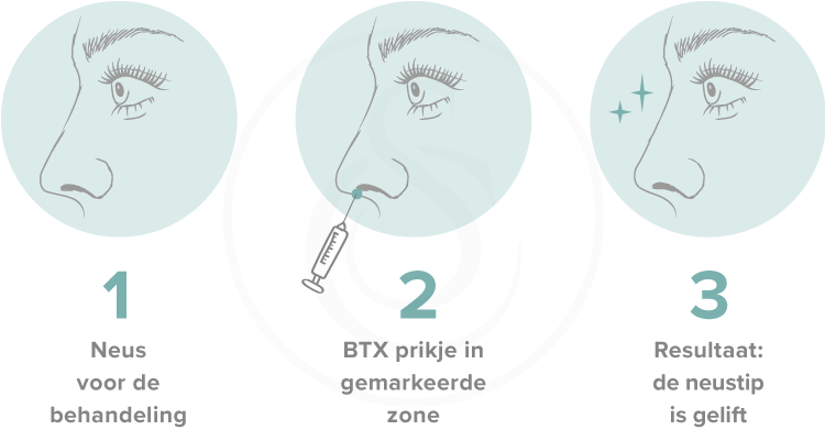 SarasinClinic_BTX-Neustiplift_stap-voor-stap_web behandelprocedure neustiplift sarasin clinic