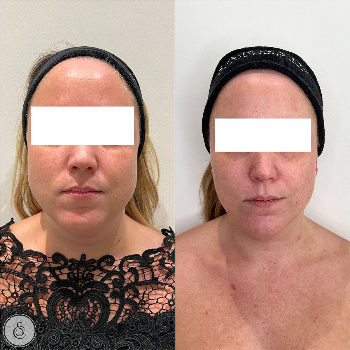 SarasinClinic_face-slimming-masseter-tox sarasin clinic face slimming botox